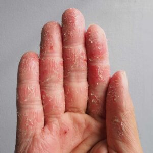 dermatite atopica mani