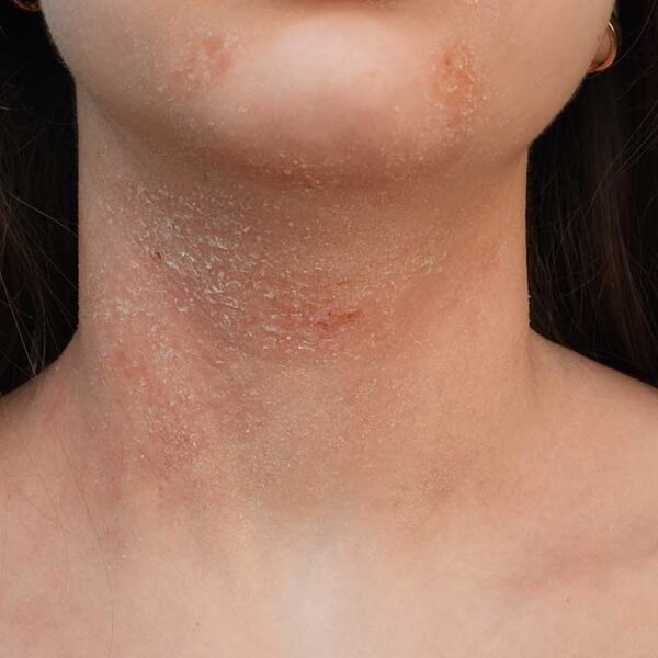 Dermatite Atopica Viso Sintomi Cause E Trattamento