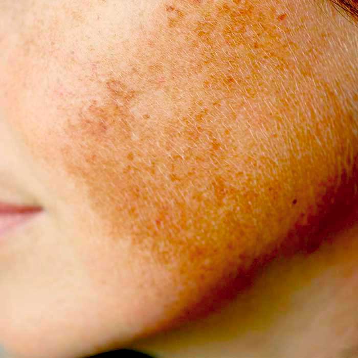 melasma