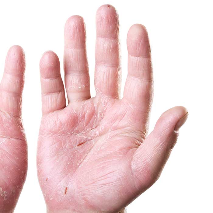 Tagli e Fissurazioni delle mani - MOST® Skincare